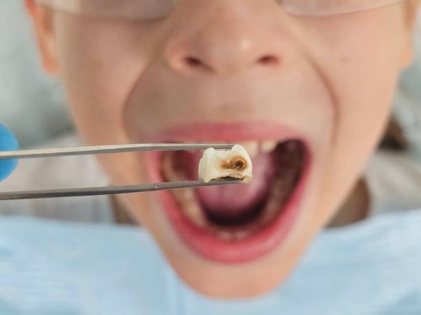 Best Emergency Wisdom Tooth Extraction in Danville, CA